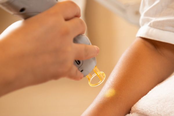 Skin tag removal by RF cautery at MK Aesthetics, Juhu, Mumbai