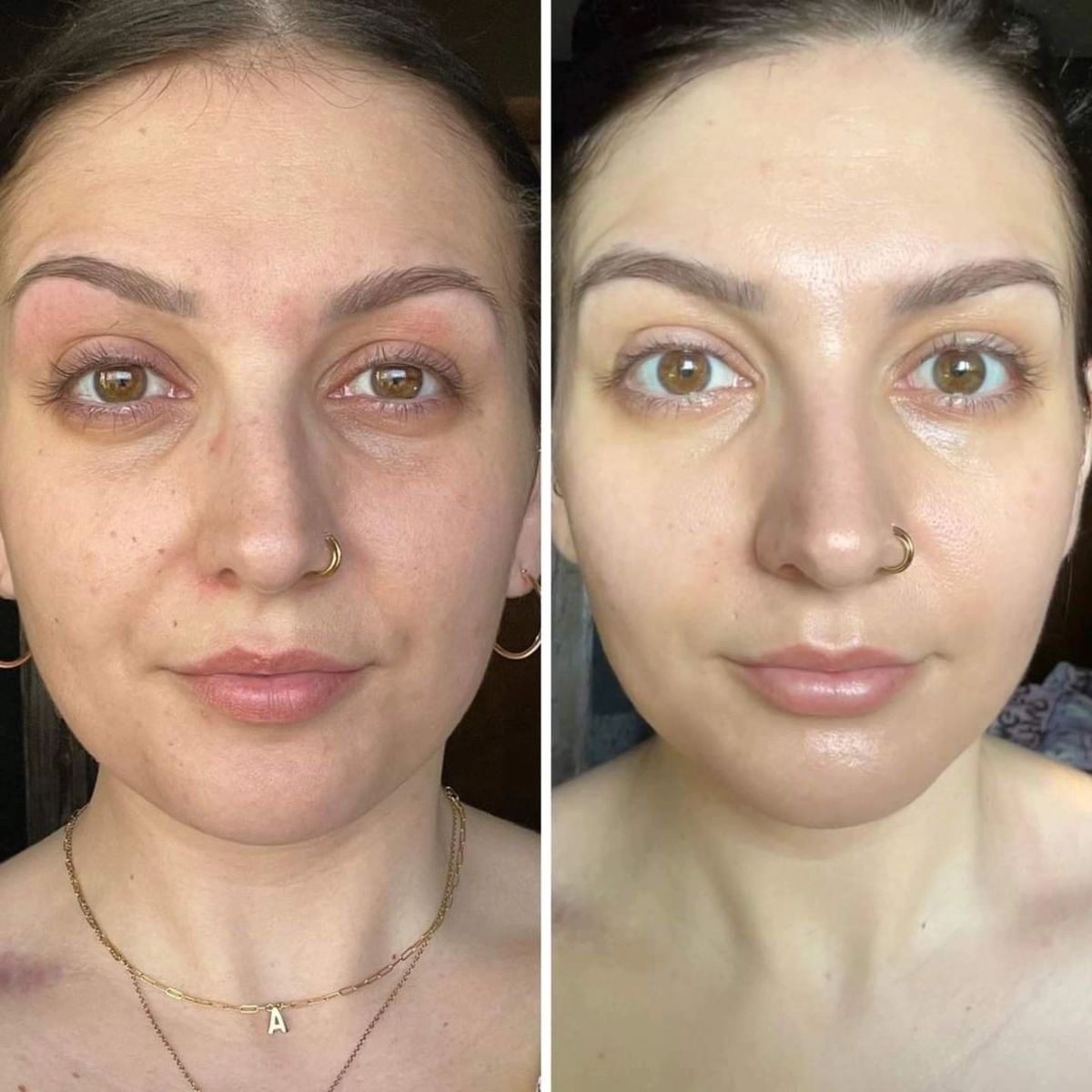 Client result at MK Aesthetics, Juhu, shared with consent