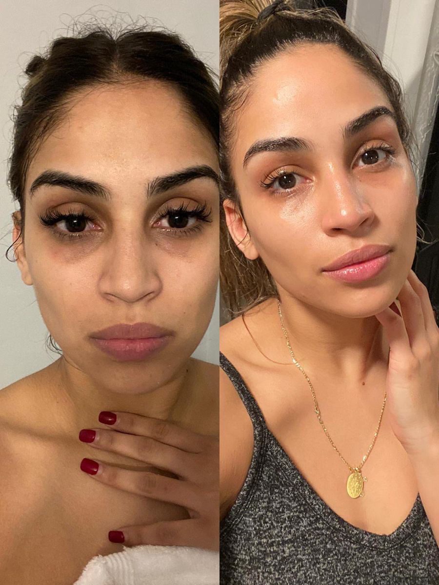 Client result at MK Aesthetics, Juhu, shared with consent
