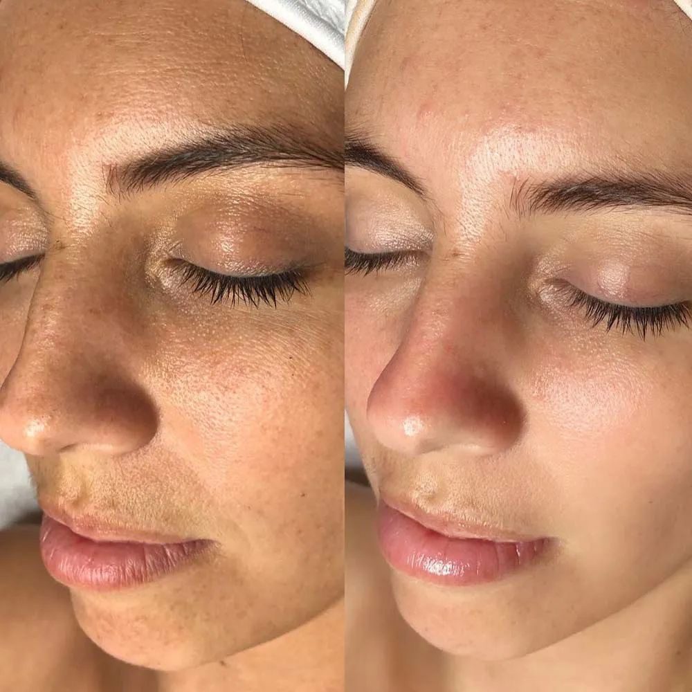 Client result at MK Aesthetics, Juhu, shared with consent
