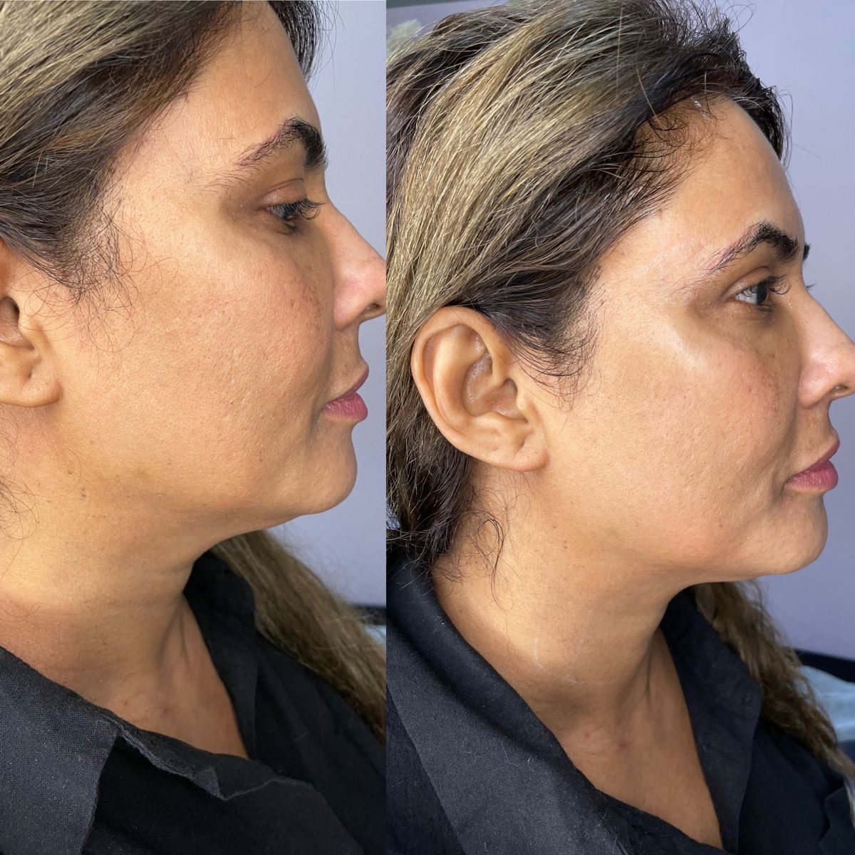 Client result at MK Aesthetics, Juhu, shared with consent