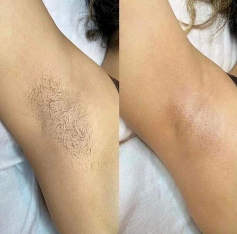 Treatment result at MK Aesthetics, Juhu, shared with consent