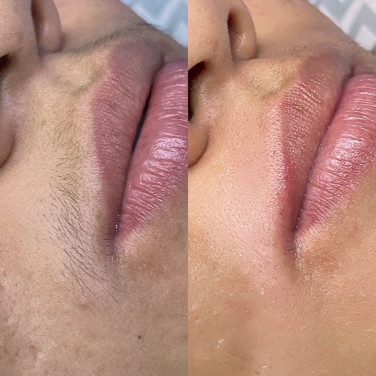 Treatment result at MK Aesthetics, Juhu, shared with consent