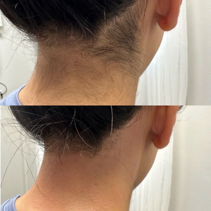 Treatment result at MK Aesthetics, Juhu, shared with consent