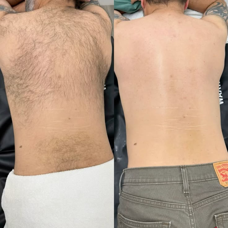 Treatment result at MK Aesthetics, Juhu, shared with consent