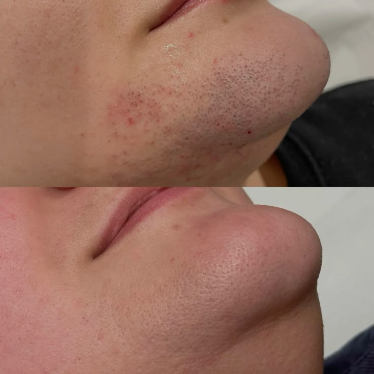 Laser hair reduction result at MK Aesthetics, Juhu, shared with consent
