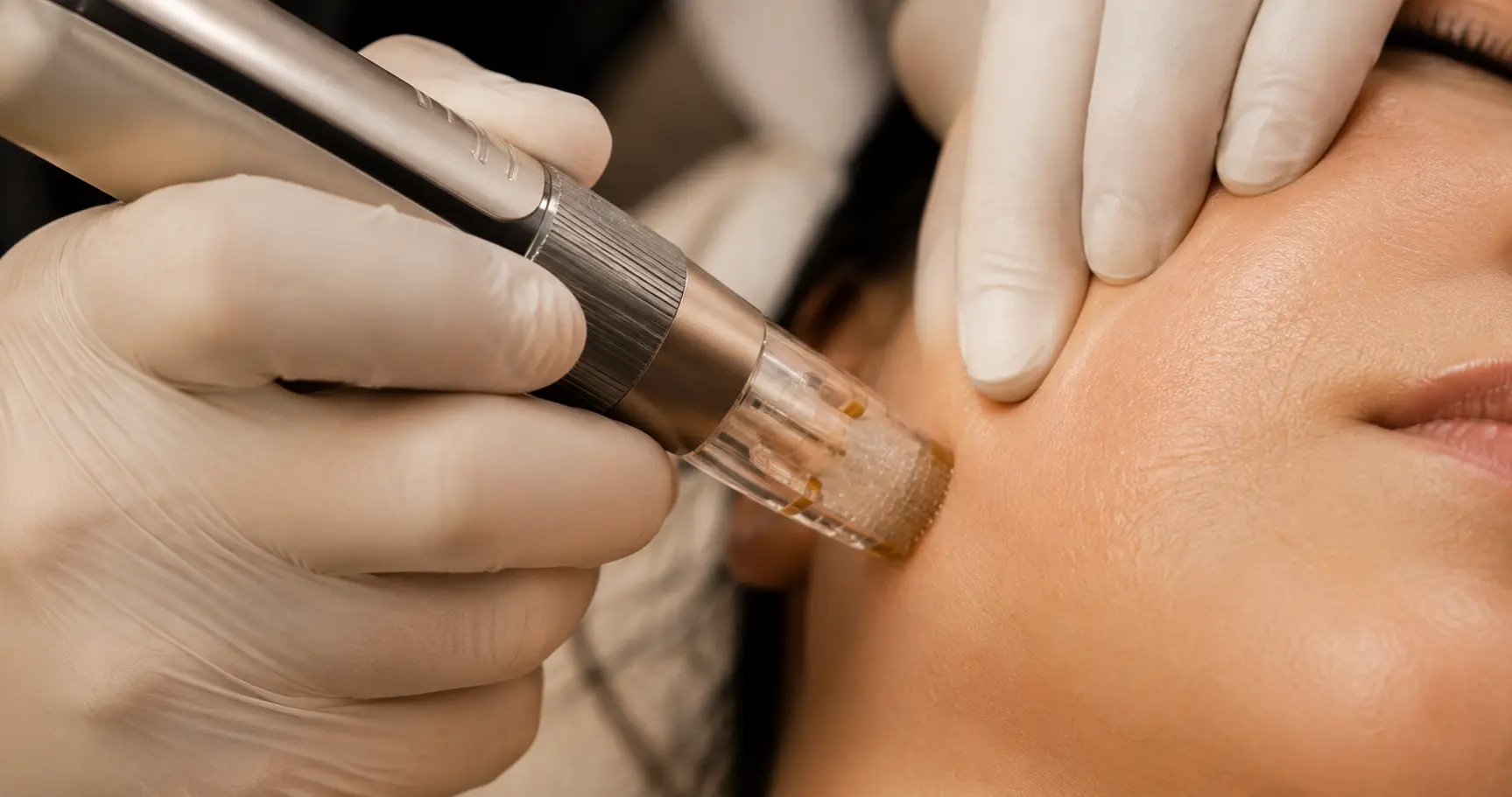 MNRF for Acne Scars: What Micro-Needling with Radio frequency Actually Fixes